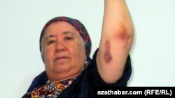 Солтан Ачилова, корреспондент Радио Азатлык в Туркменистане, показывает синяки на руке, полученные в результате нападения в Ашгабате в октябре 2016 года.